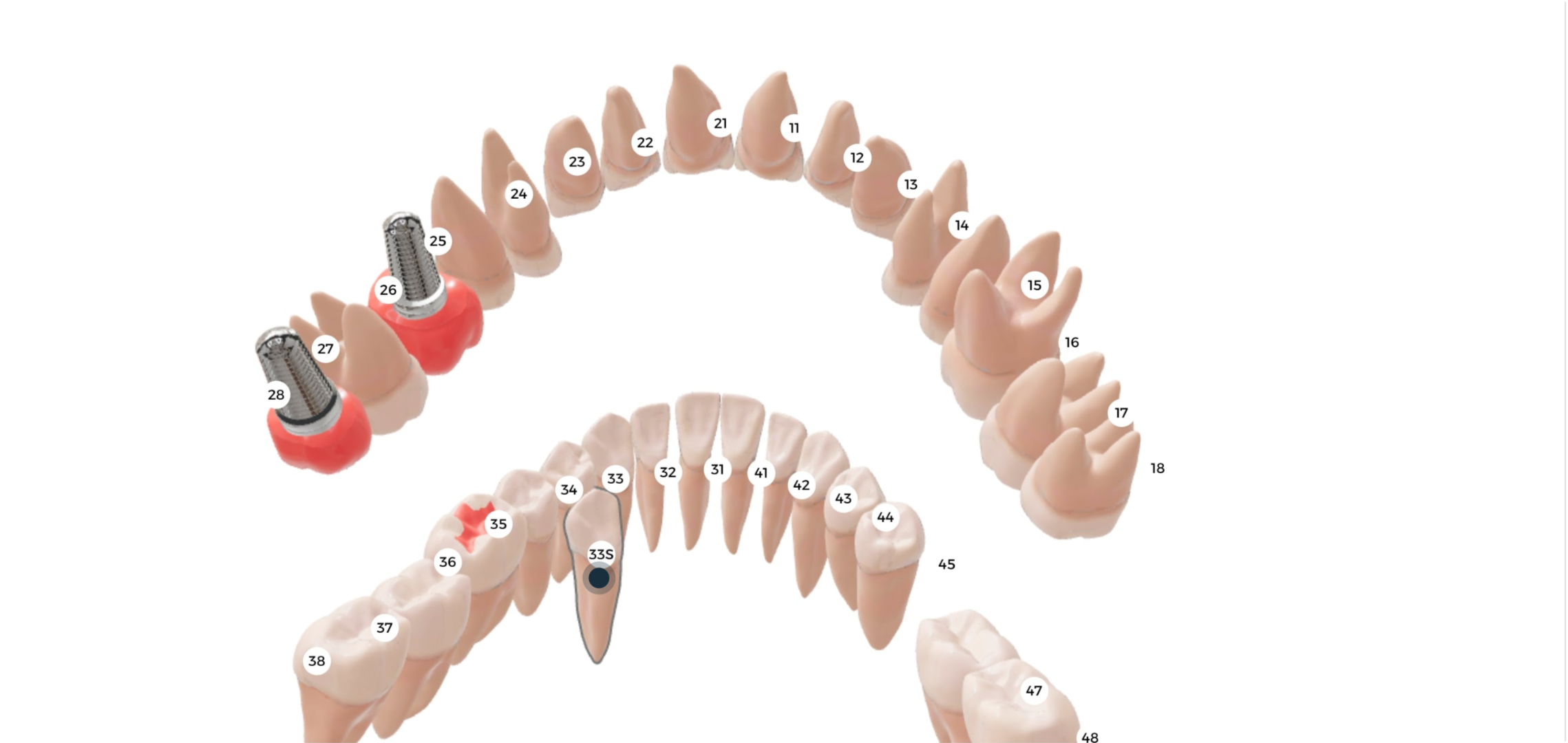 Step 4 - Supernumerary tooth added to the chart