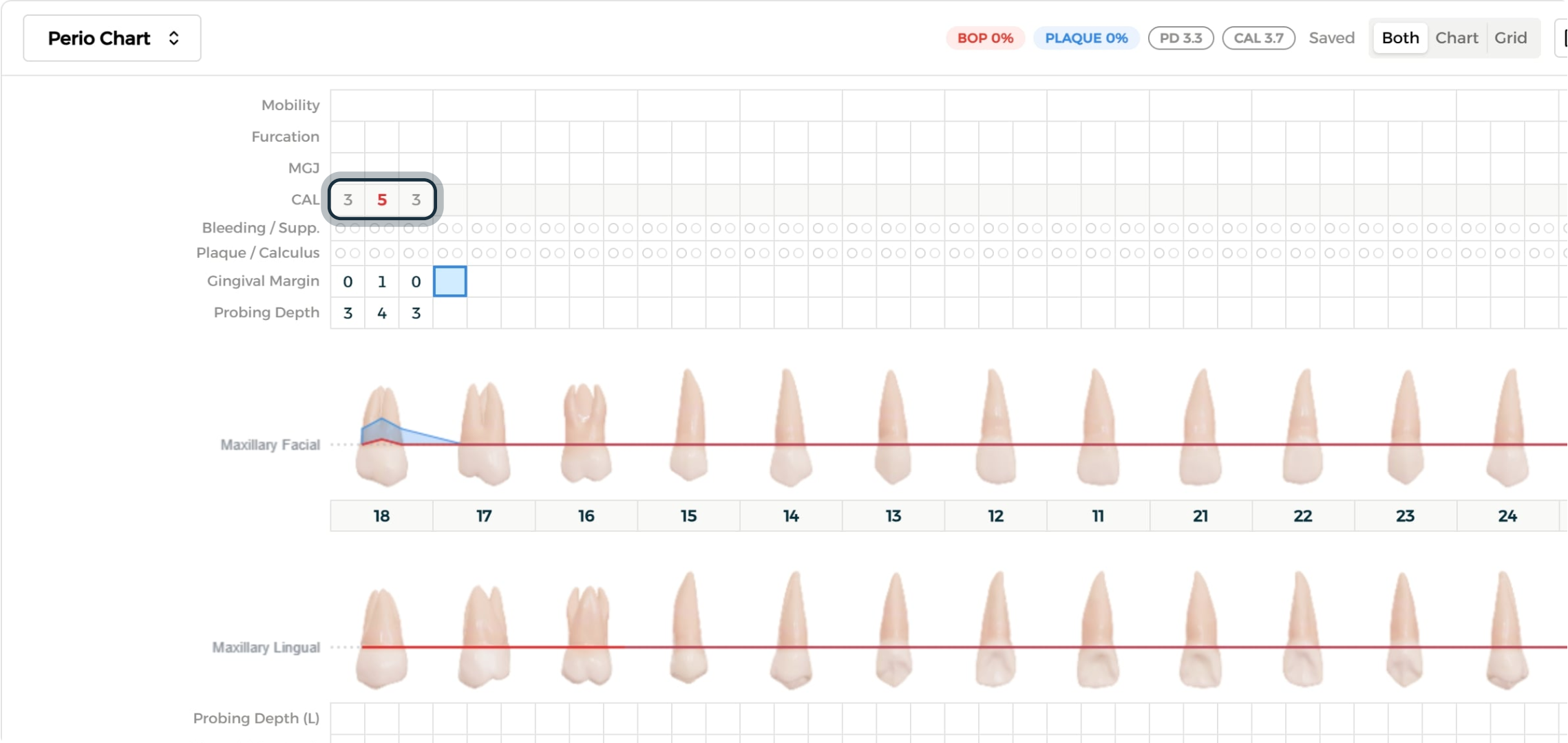 Step 2 - Gingival margin and attachment level